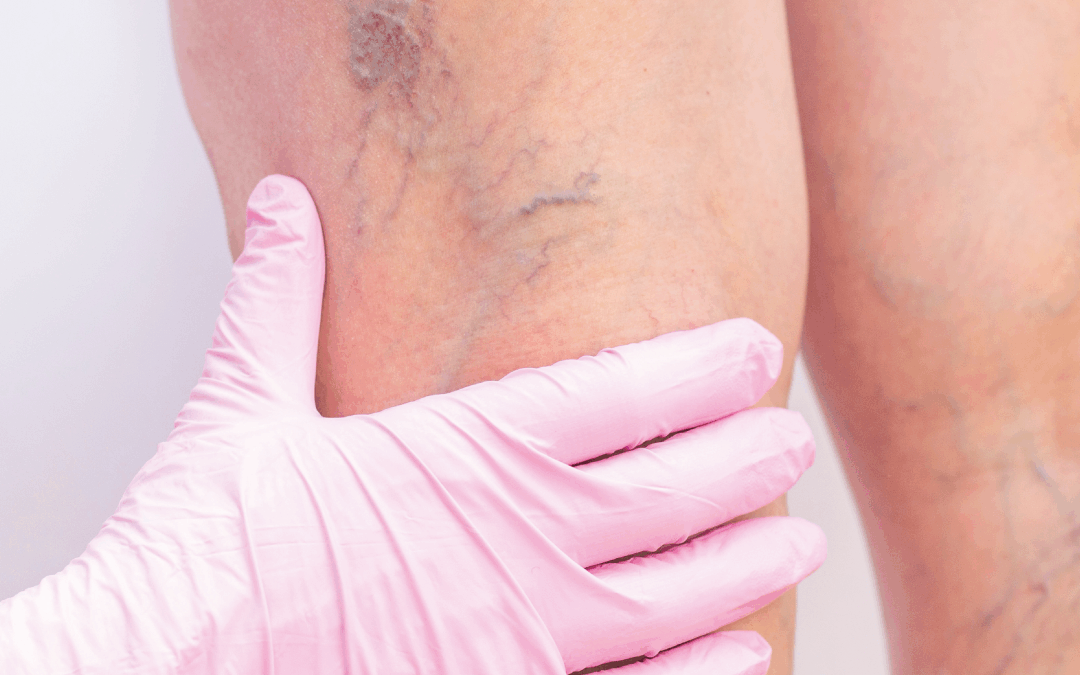 La salute del sistema circolatorio parte da vene e arterie